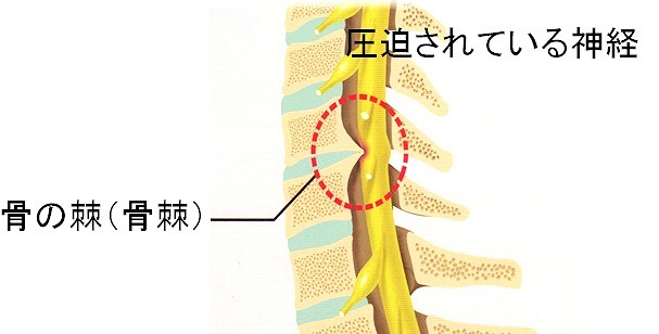 頸椎症