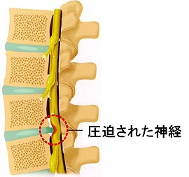 腰椎椎間板ヘルニア